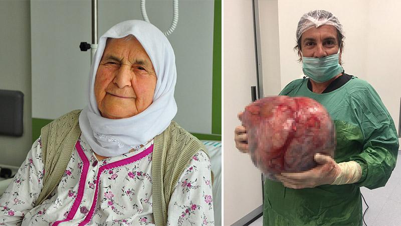 Kilo aldığını sandı, yumurtalığından 12 kiloluk kist çıktı