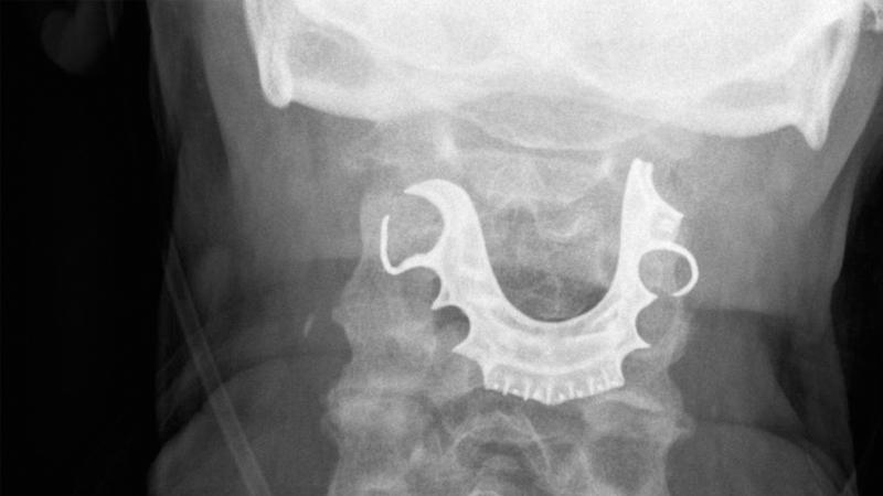 İngiltere'de ameliyatta hastanın boğazına kaçan takma dişleri 8 gün sonra fark edildi