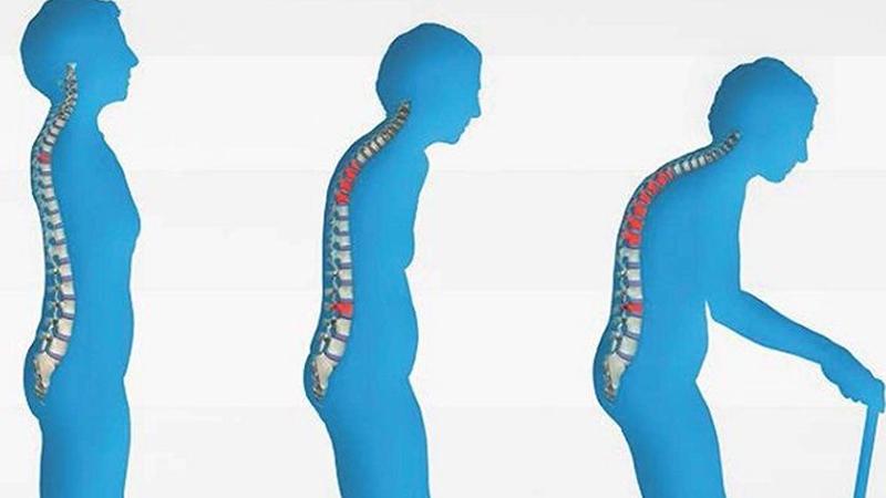 Türkiye'de "osteoporoz salgını” bekleniyor:  50 yaş üzeri 3 kadından ve 5 erkekten 1’inde kırığa neden oluyor