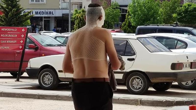 Fabrikada buhar hortumu patladı, işçinin yüzü ve vücudu yandı