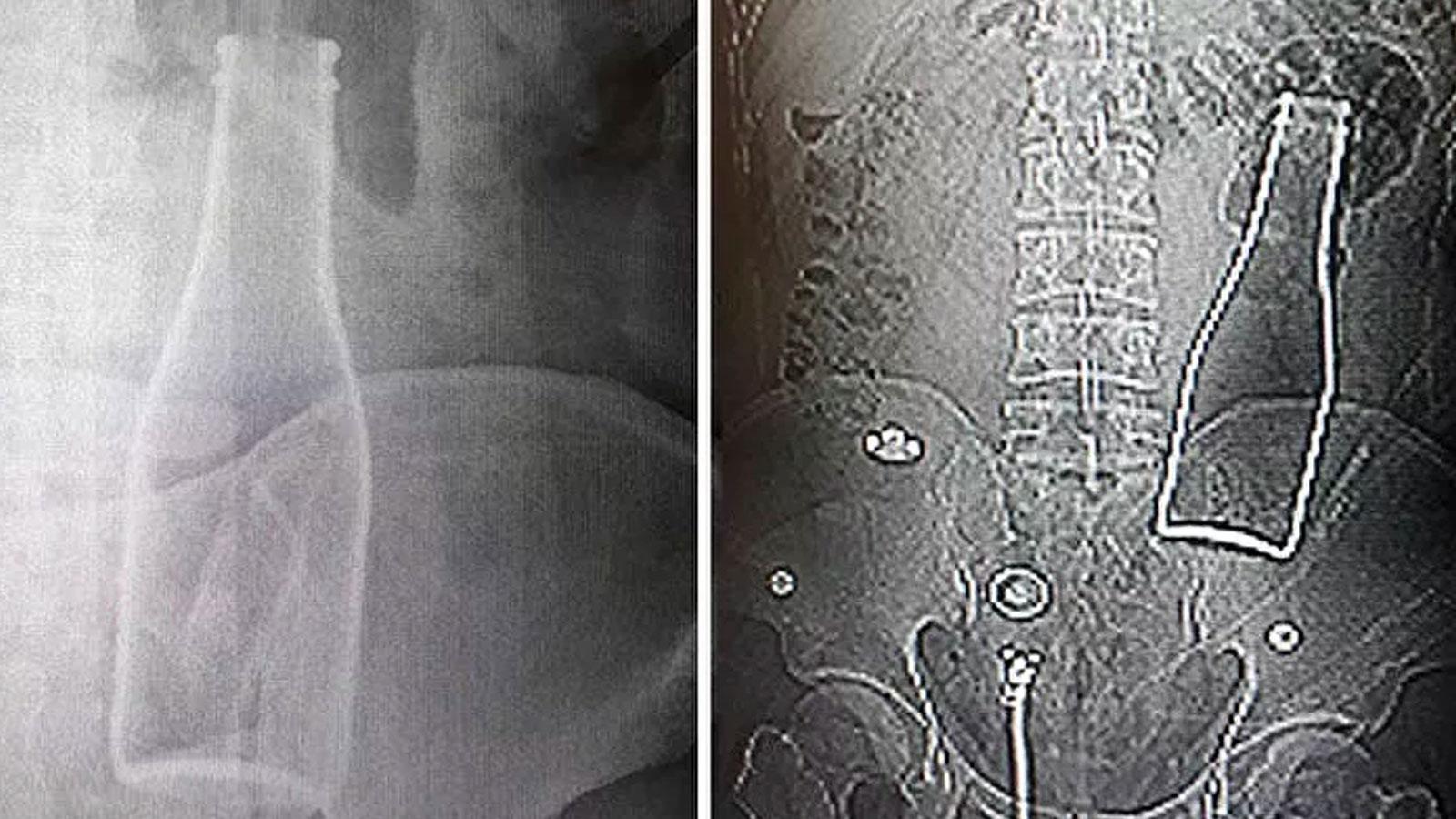 Karın ağrısı şikâyetiyle gittiği hastanede, vücudunda şişe olduğu ortaya çıktı