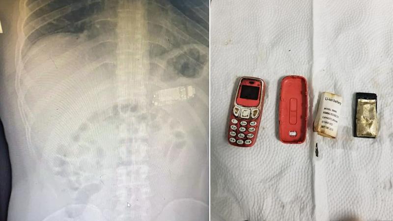 Doktorları şaşırtan ameliyat: Midesinden Nokia 3310 çıktı