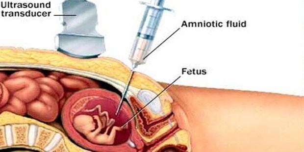 Amniyosentez tarihe karışıyor