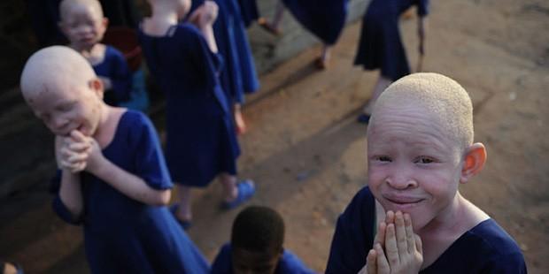 Tanzanya'da albino cinayeti